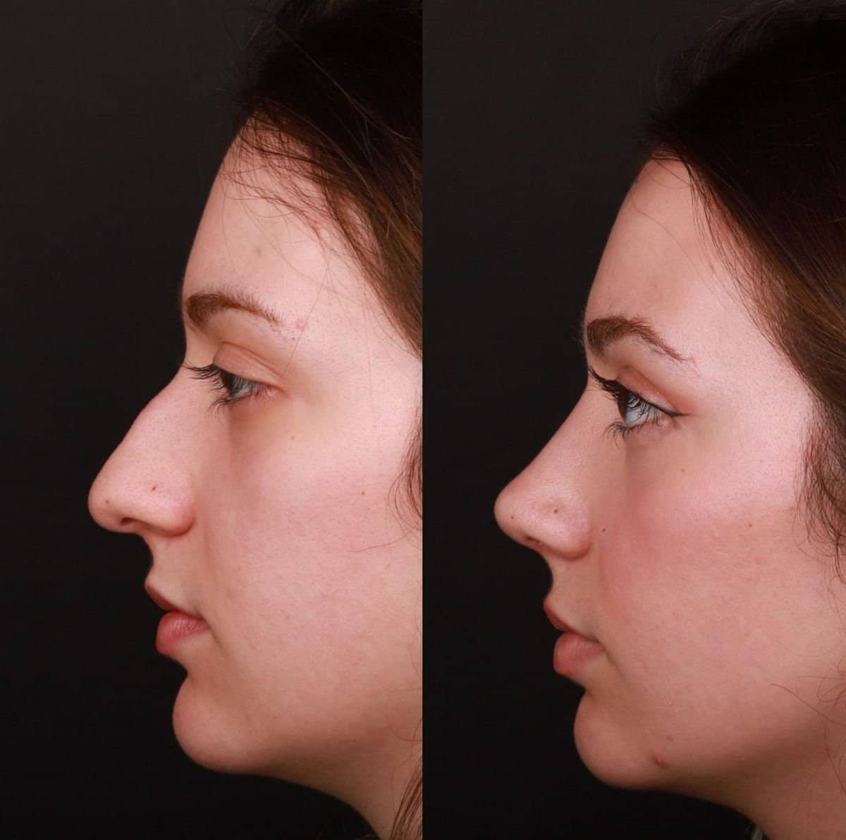Case 21144 - tip rhinoplasty