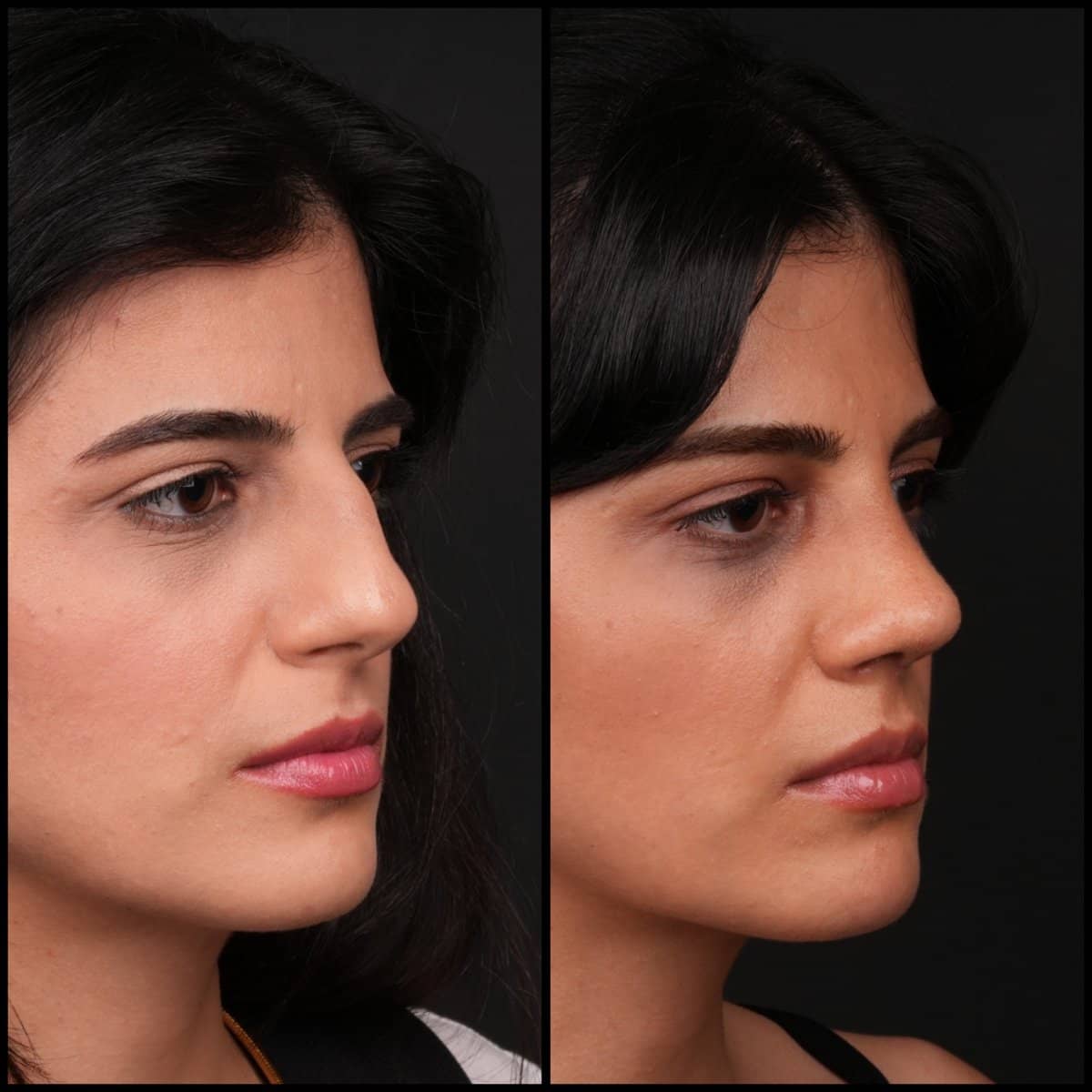 Case 21145 - rhinoplasty