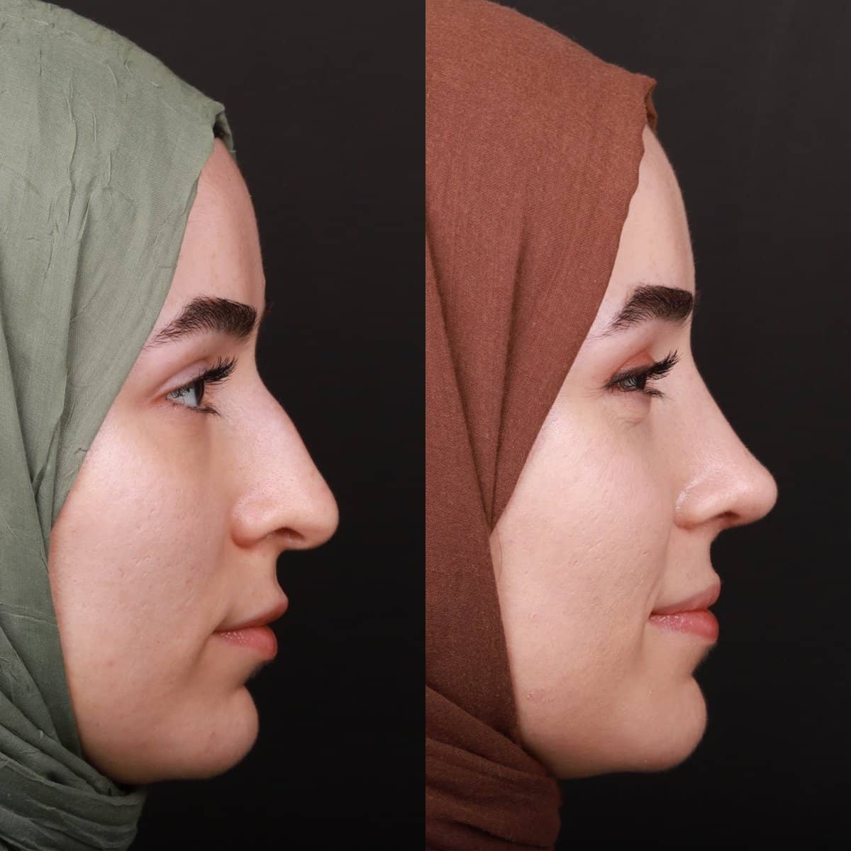 Case 21146 - rhinoplasty