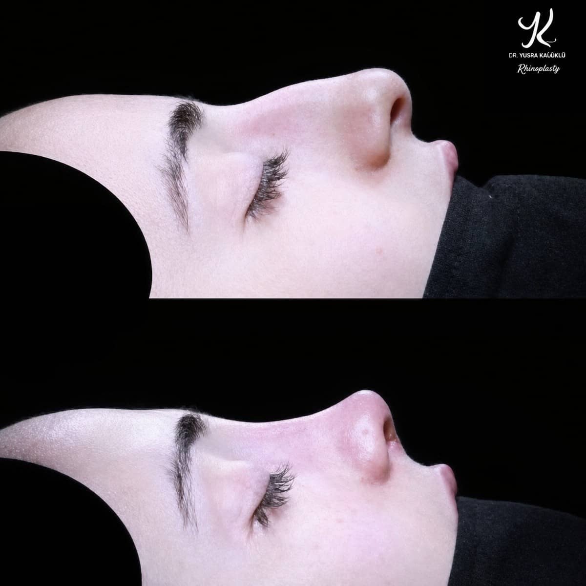 Case 21147 - tip rhinoplasty