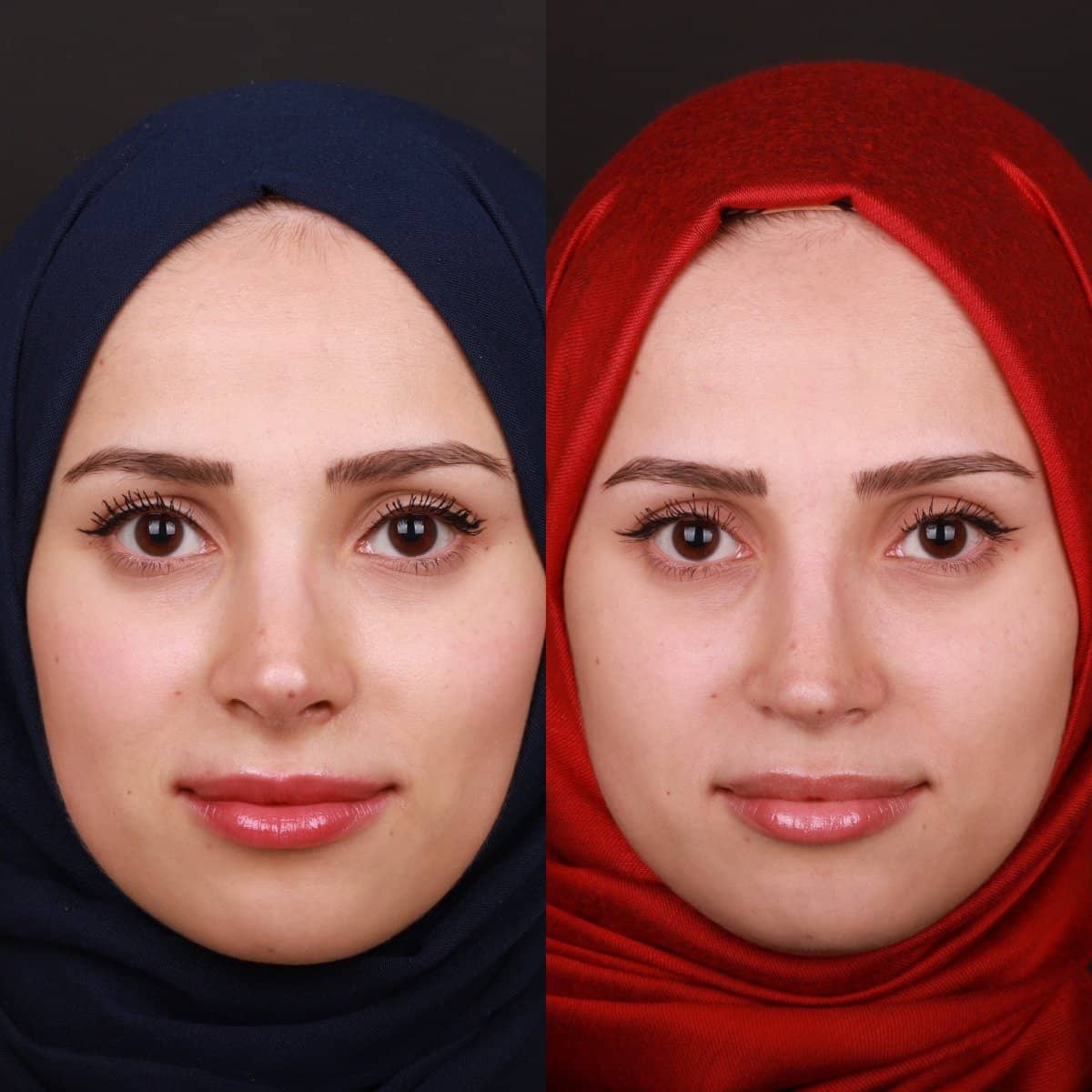 Case 21148 - revision rhinoplasty