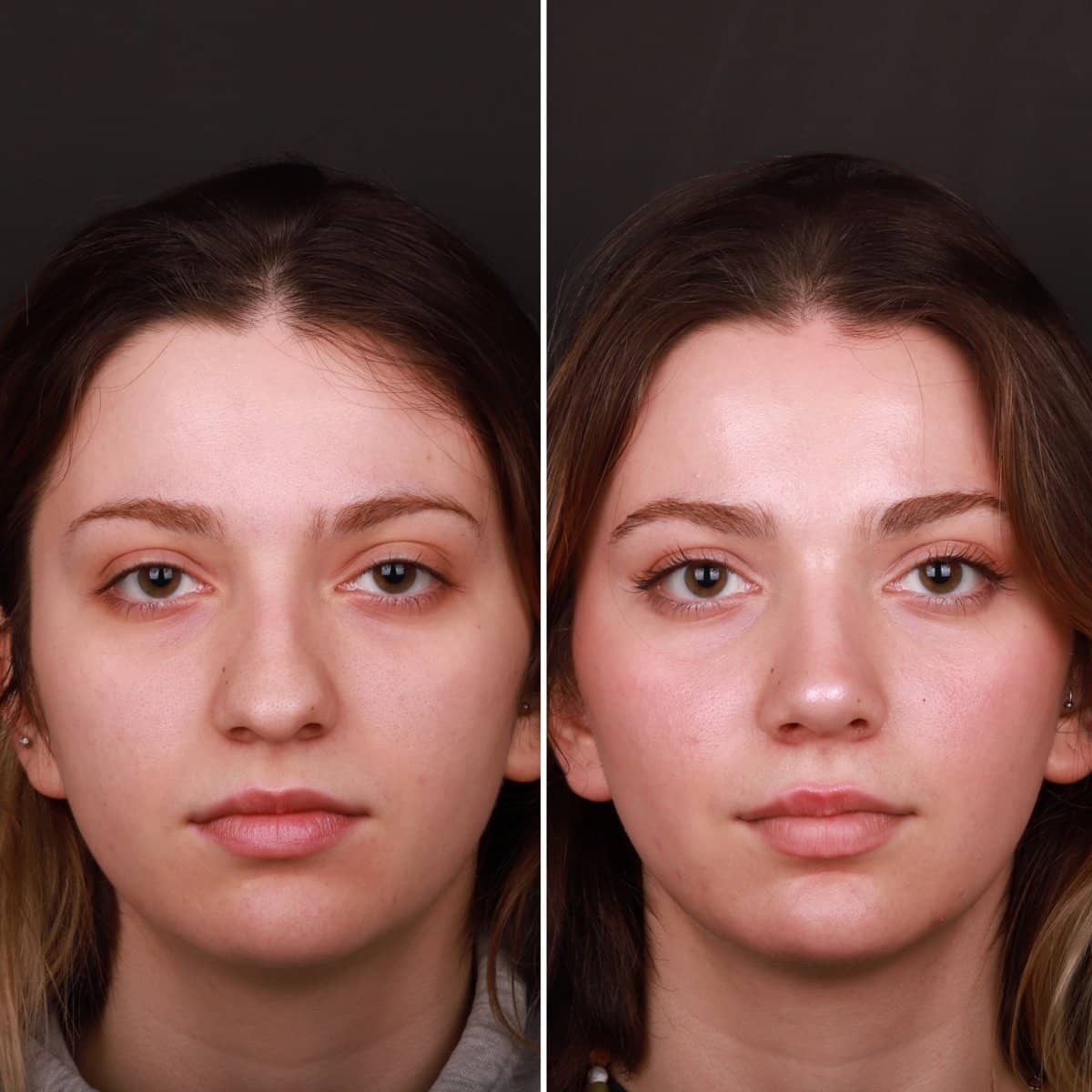 Case 21149 - rhinoplasty