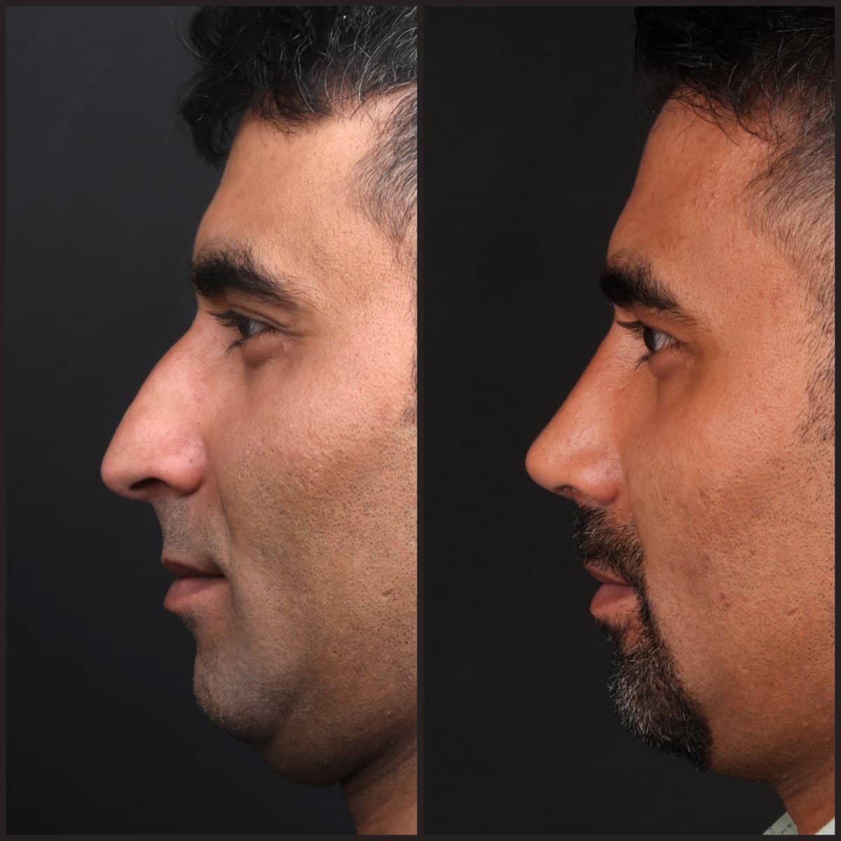 Case 21150 - rhinoplasty