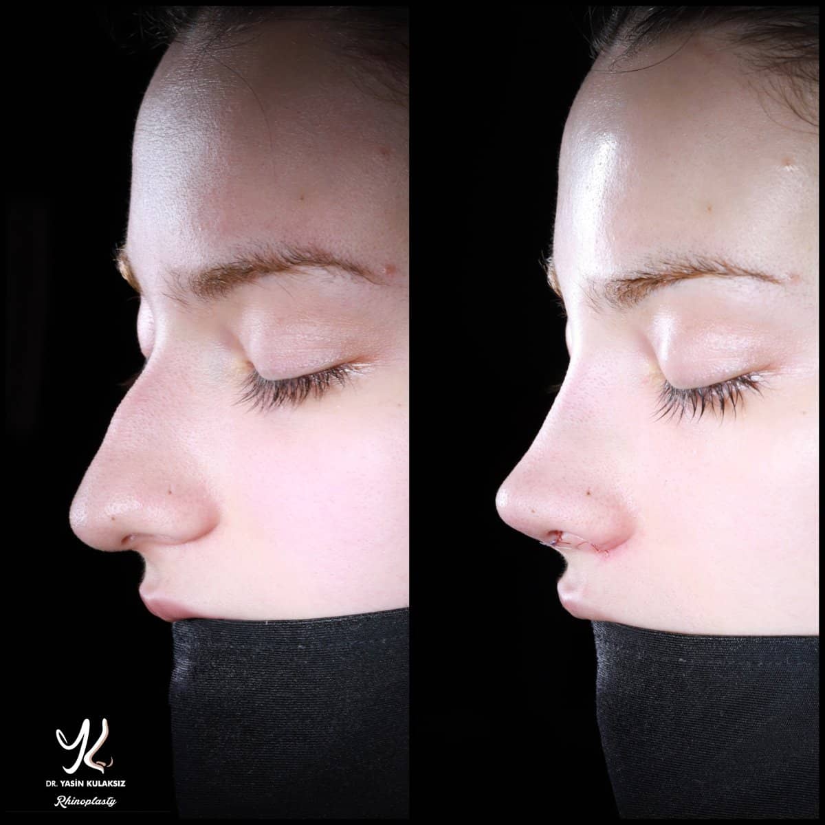 Case 21151 - rhinoplasty