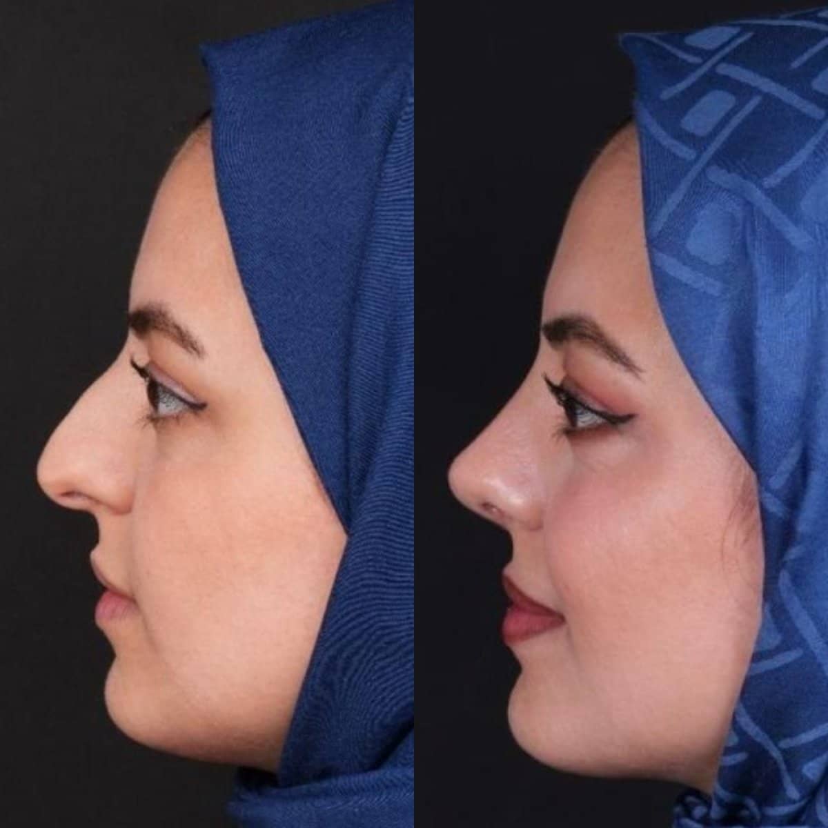 Case 21152 - tip rhinoplasty