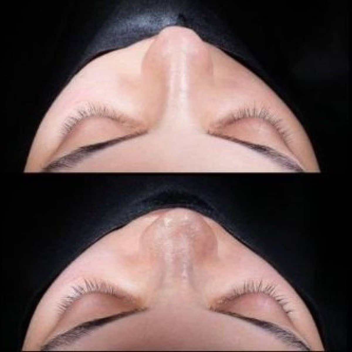 Case 21154 - tip rhinoplasty