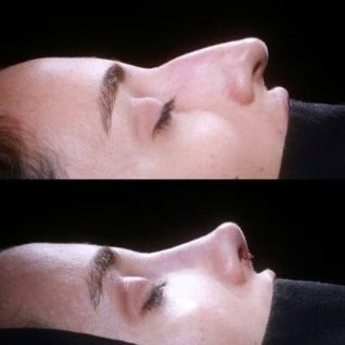 Case 21156 - tip rhinoplasty