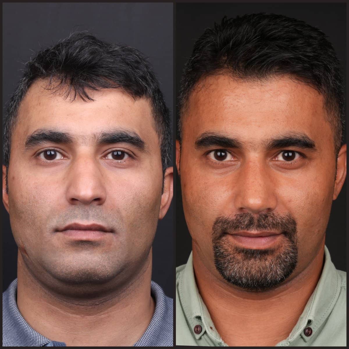 Case 21160 - FUE hair transplant