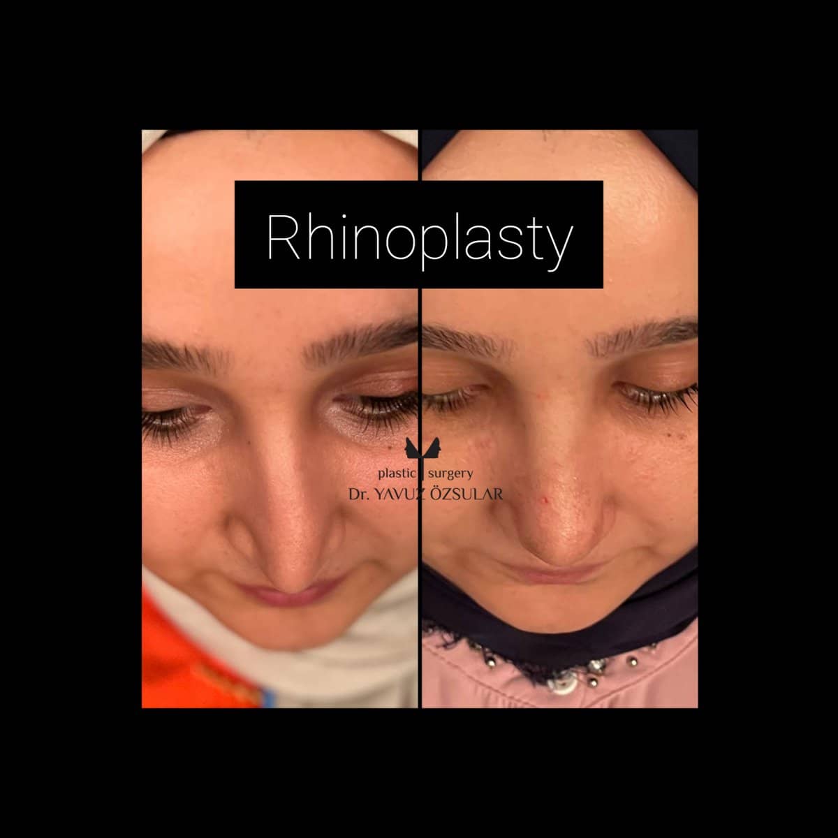 Case 21168 - rhinoplasty