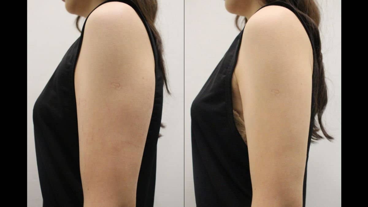 Case 21183 - liquid liposuction