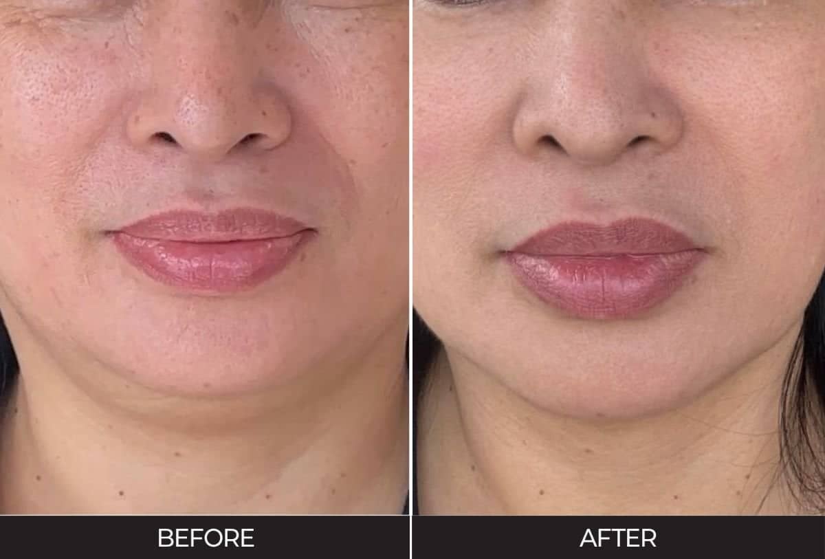 Case 21189 - stem cell rejuvenation therapy