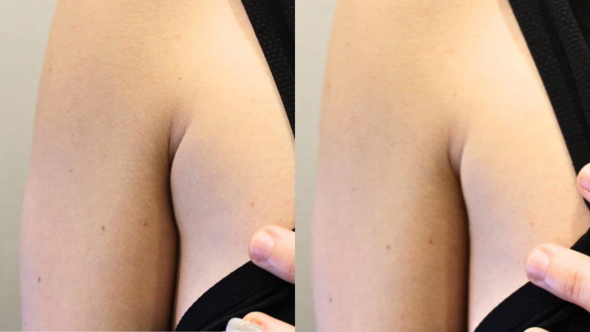 Case 21192 - liquid liposuction arm contouring