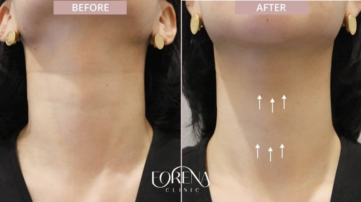 Case 21195 - hyaluronic acid fillers for neck rejuvenation
