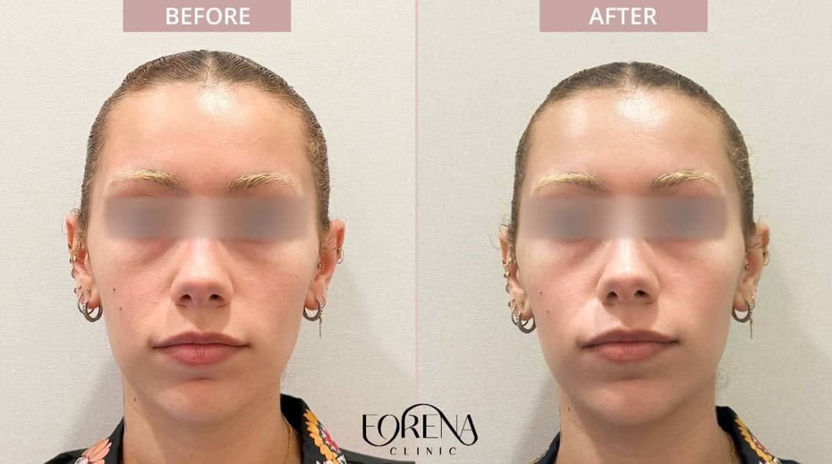 Case 21196 - skin rejuvenation