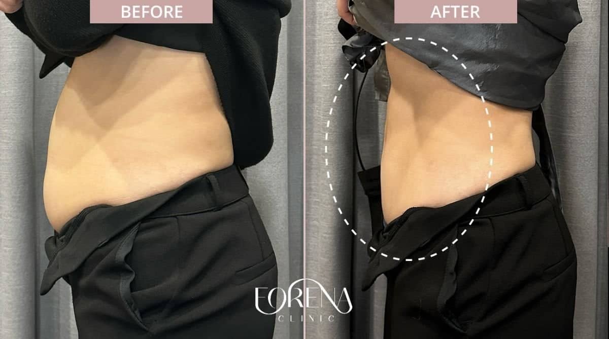Case 21199 - BodyTite body contouring