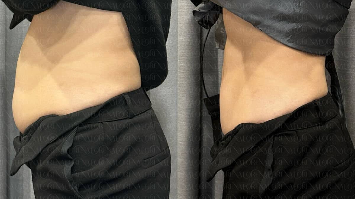 Case 21200 - liquid liposuction