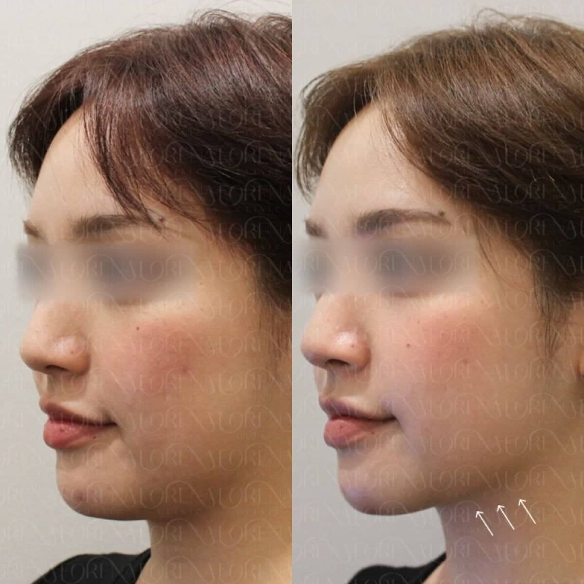 Case 21201 - Ultherapy