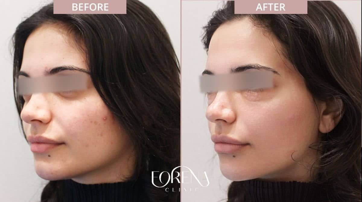 Case 21203 - skin rejuvenation