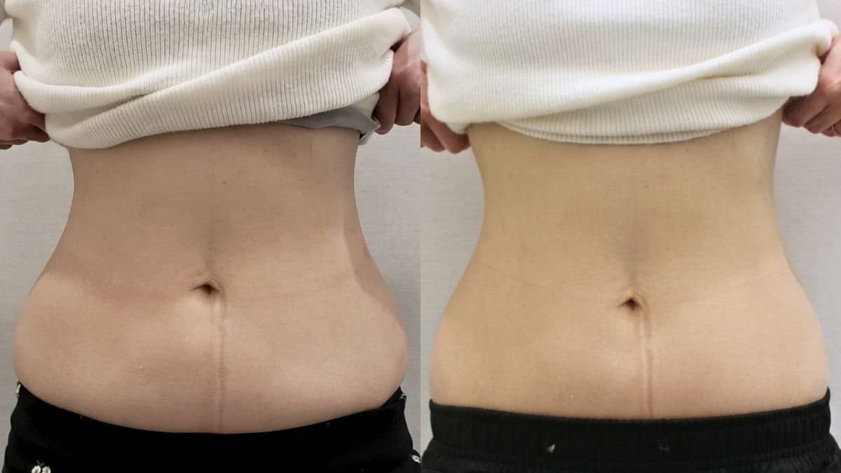 Case 21204 - liquid liposuction