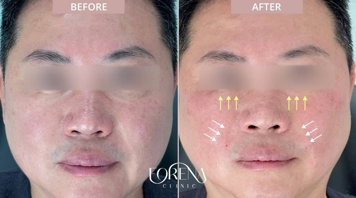 Case 21205 - fillers injection
