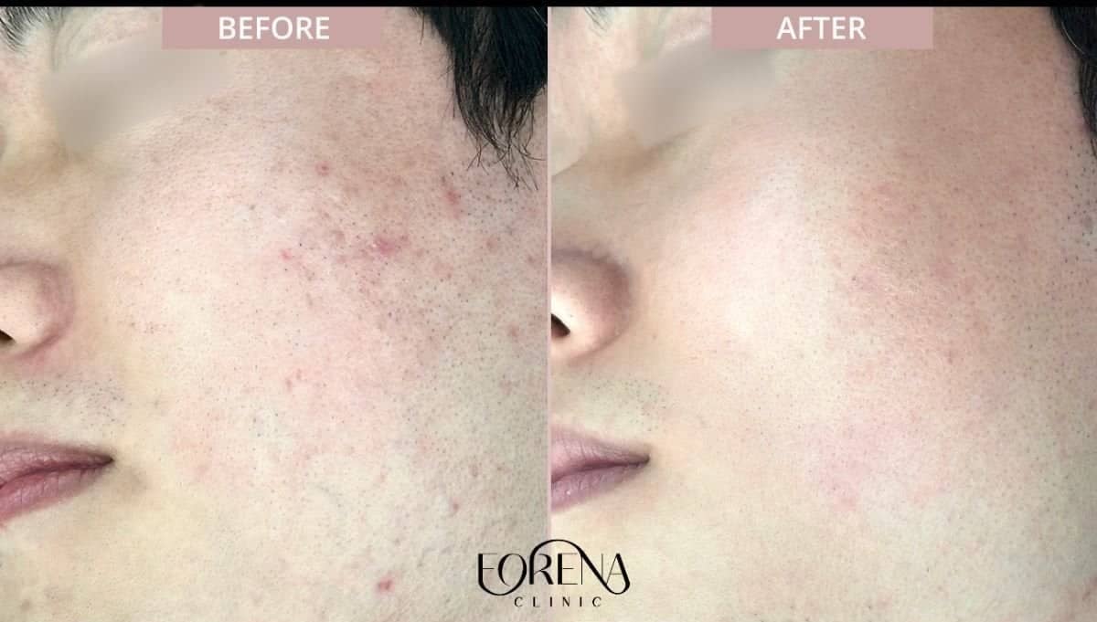 Case 21206 - acne scar treatment
