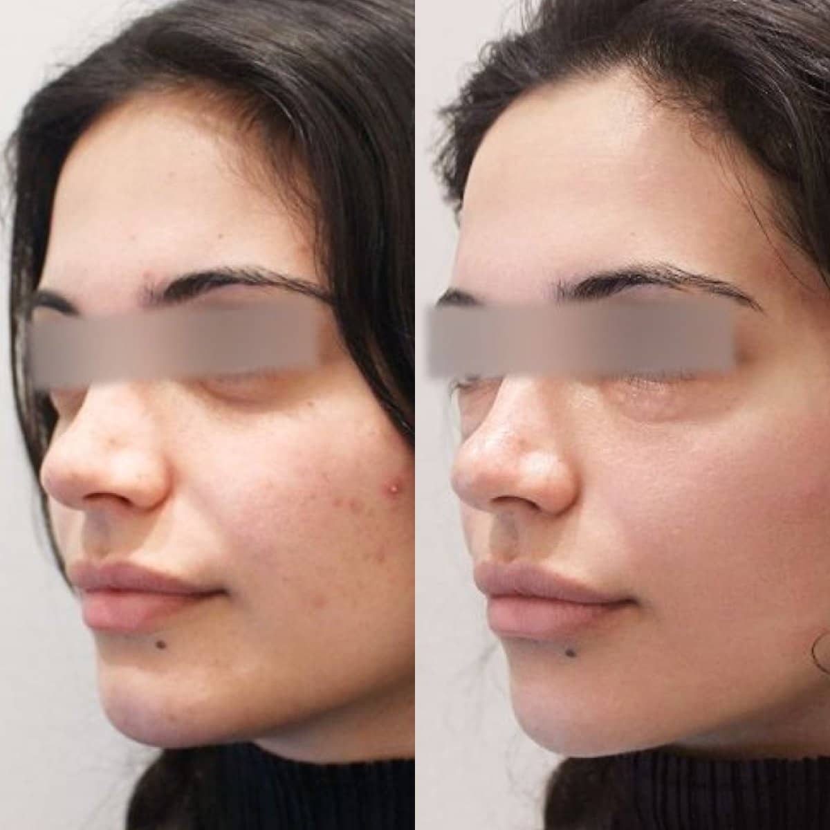 Case 21207 - Botox injections