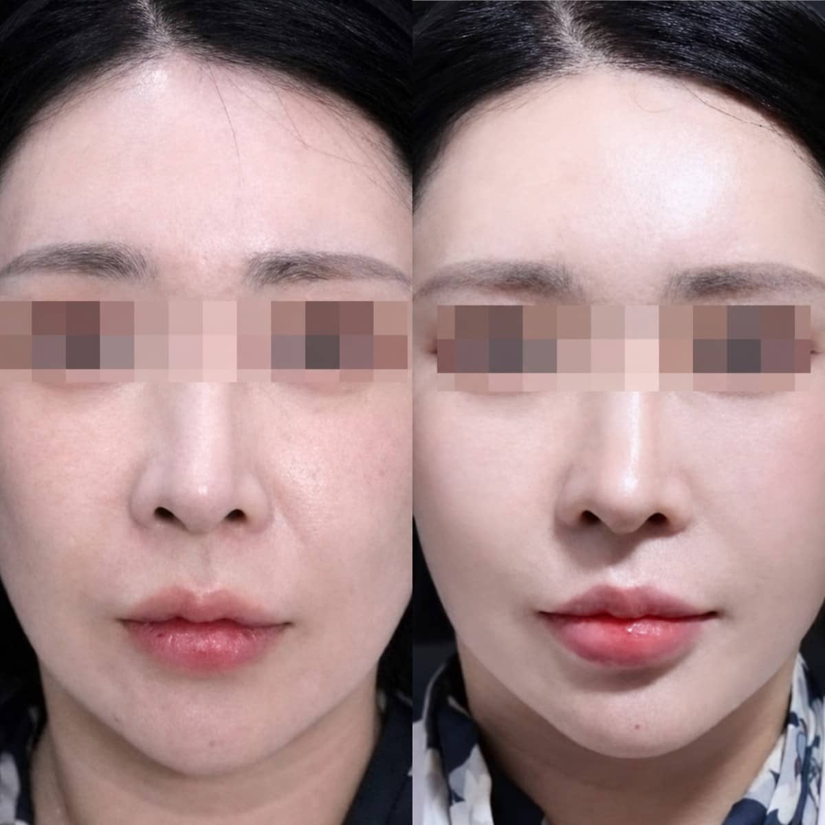 Case 21237 - endoscopic facelift