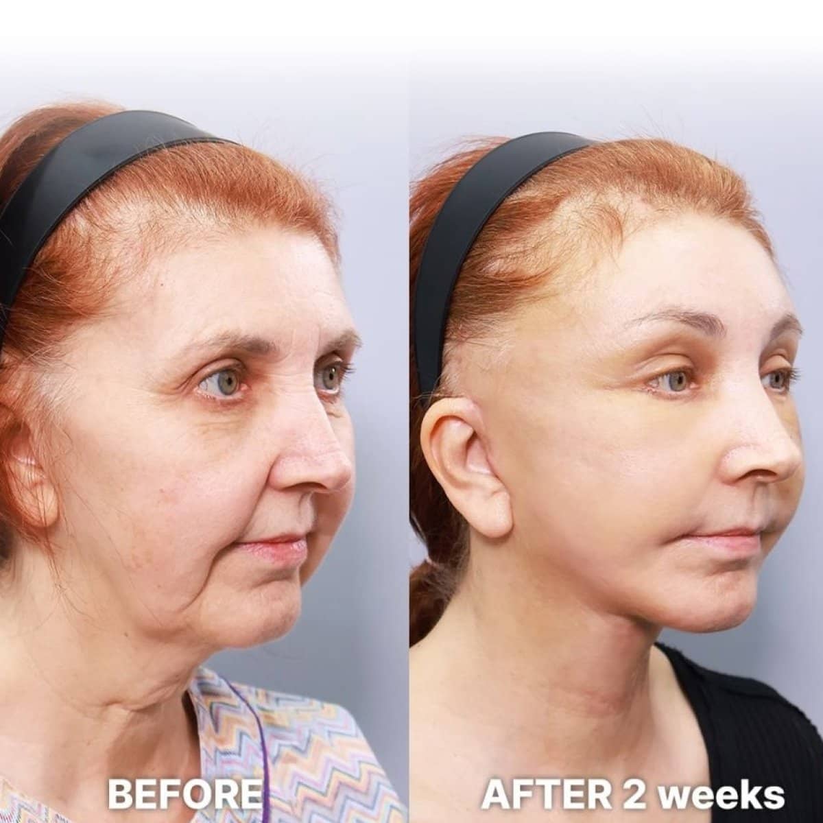 Case 21241 - deep plane facelift