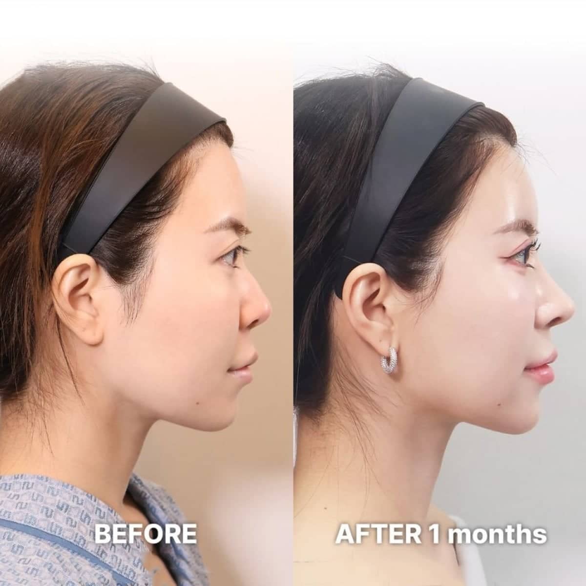 Case 21243 - revision rhinoplasty