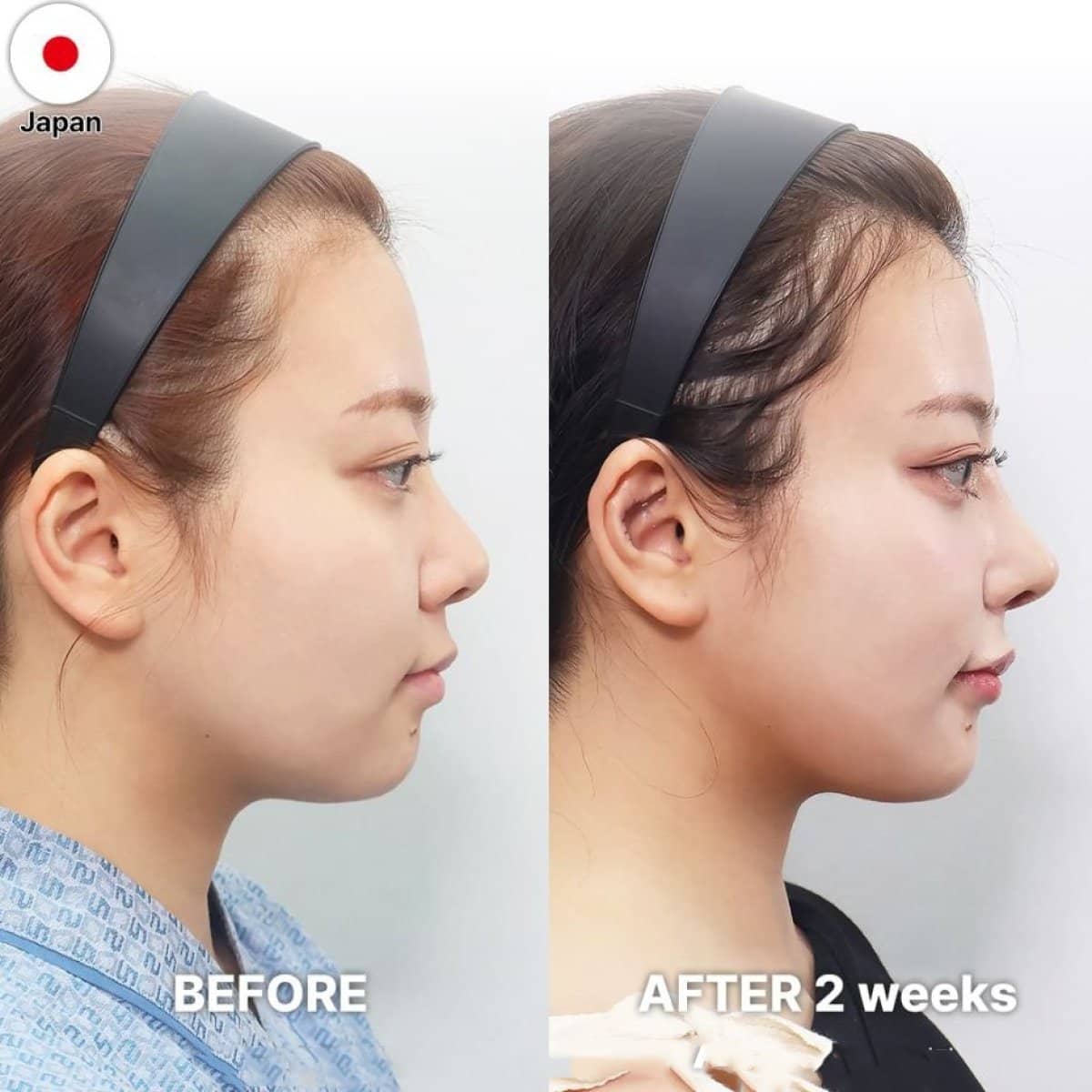 Case 21244 - revision rhinoplasty