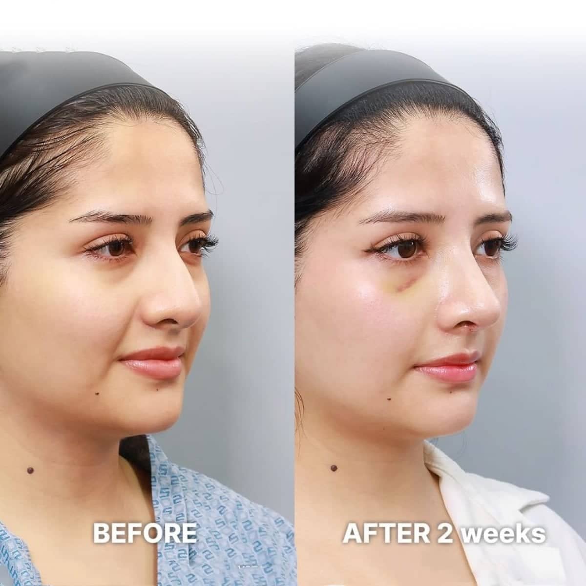 Case 21245 - tip rhinoplasty