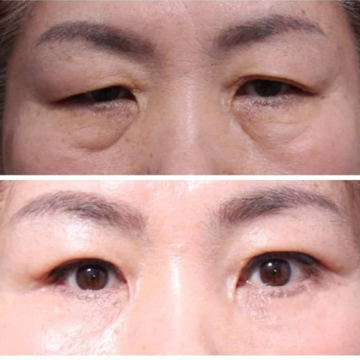 Case 21248 - lower eyelid blepharoplasty