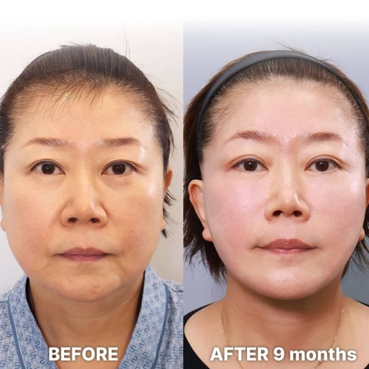 Case 21249 - deep plane facelift