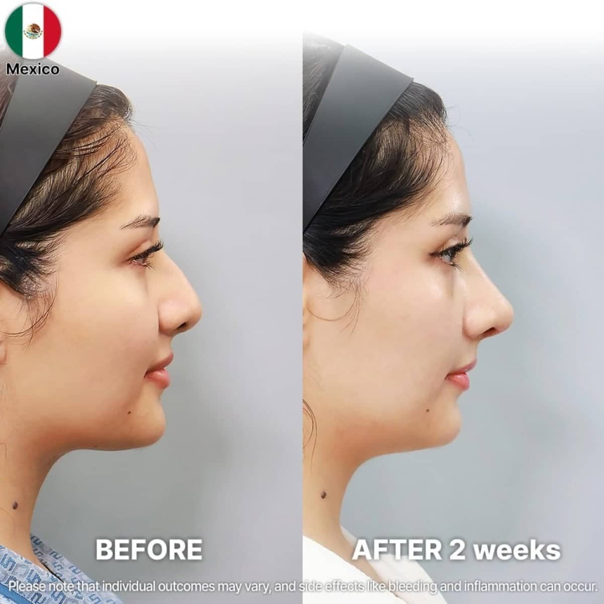 Case 21250 - rhinoplasty