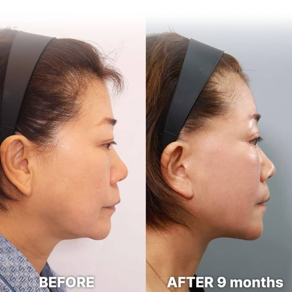 Case 21253 - deep plane facelift