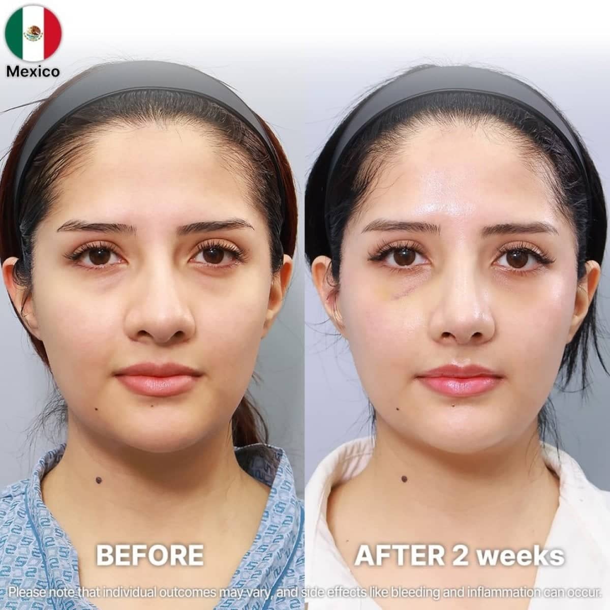 Case 21255 - rhinoplasty