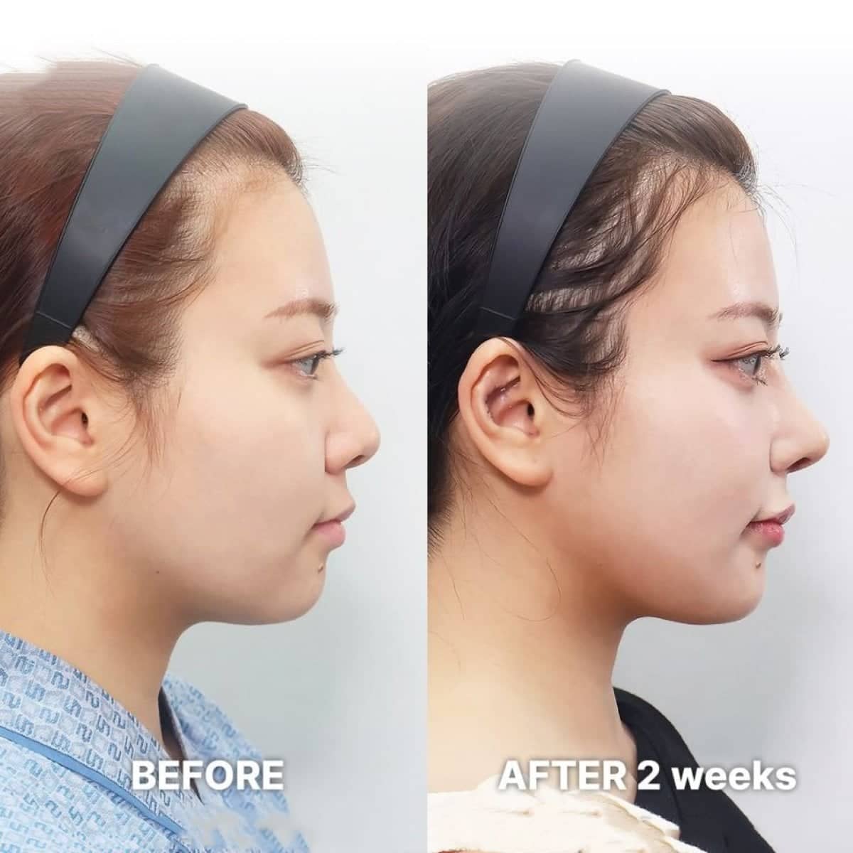 Case 21256 - tip rhinoplasty