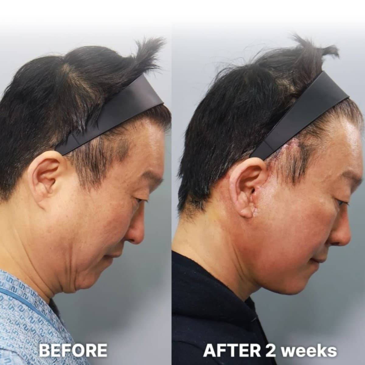 Case 21257 - endoscopic facelift