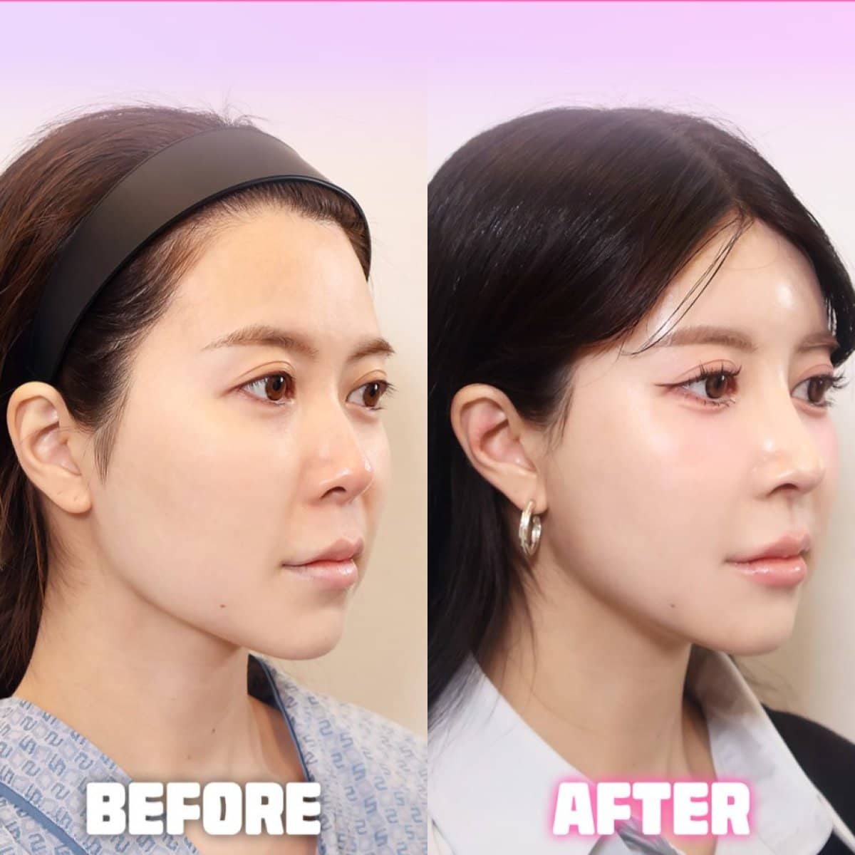 Case 21259 - rhinoplasty