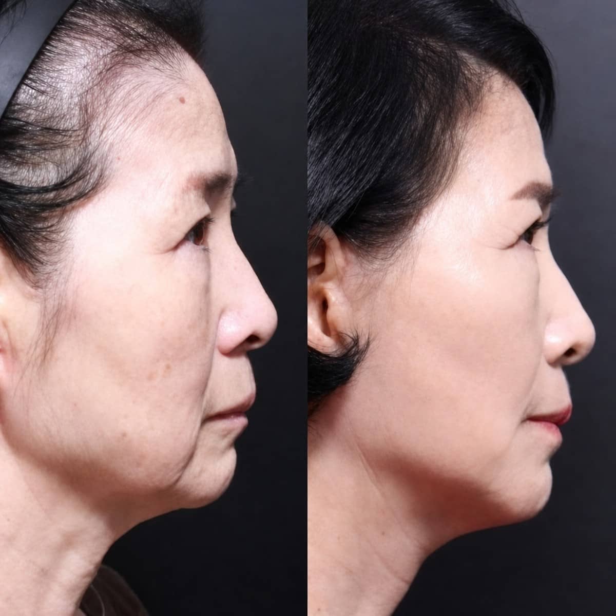Case 21263 - neck lift