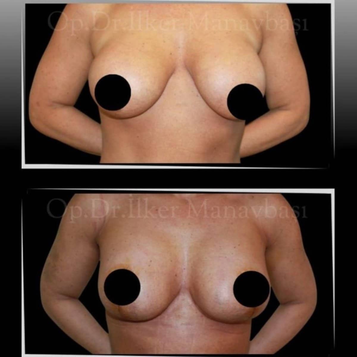 Case 21334 - breast lift