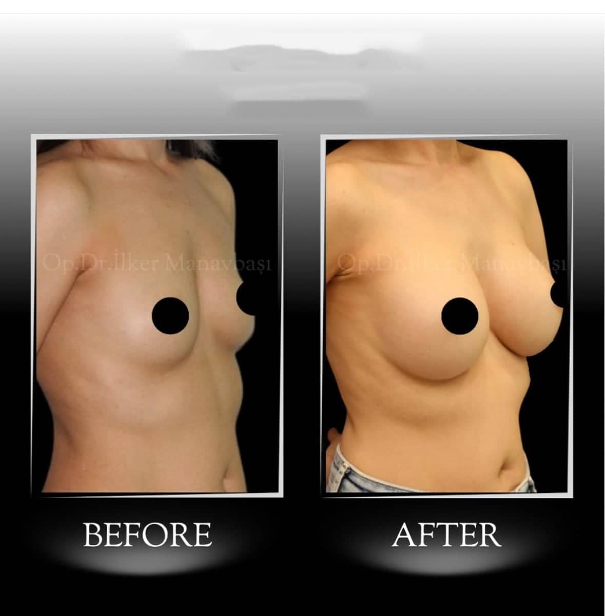 Case 21335 - breast augmentation