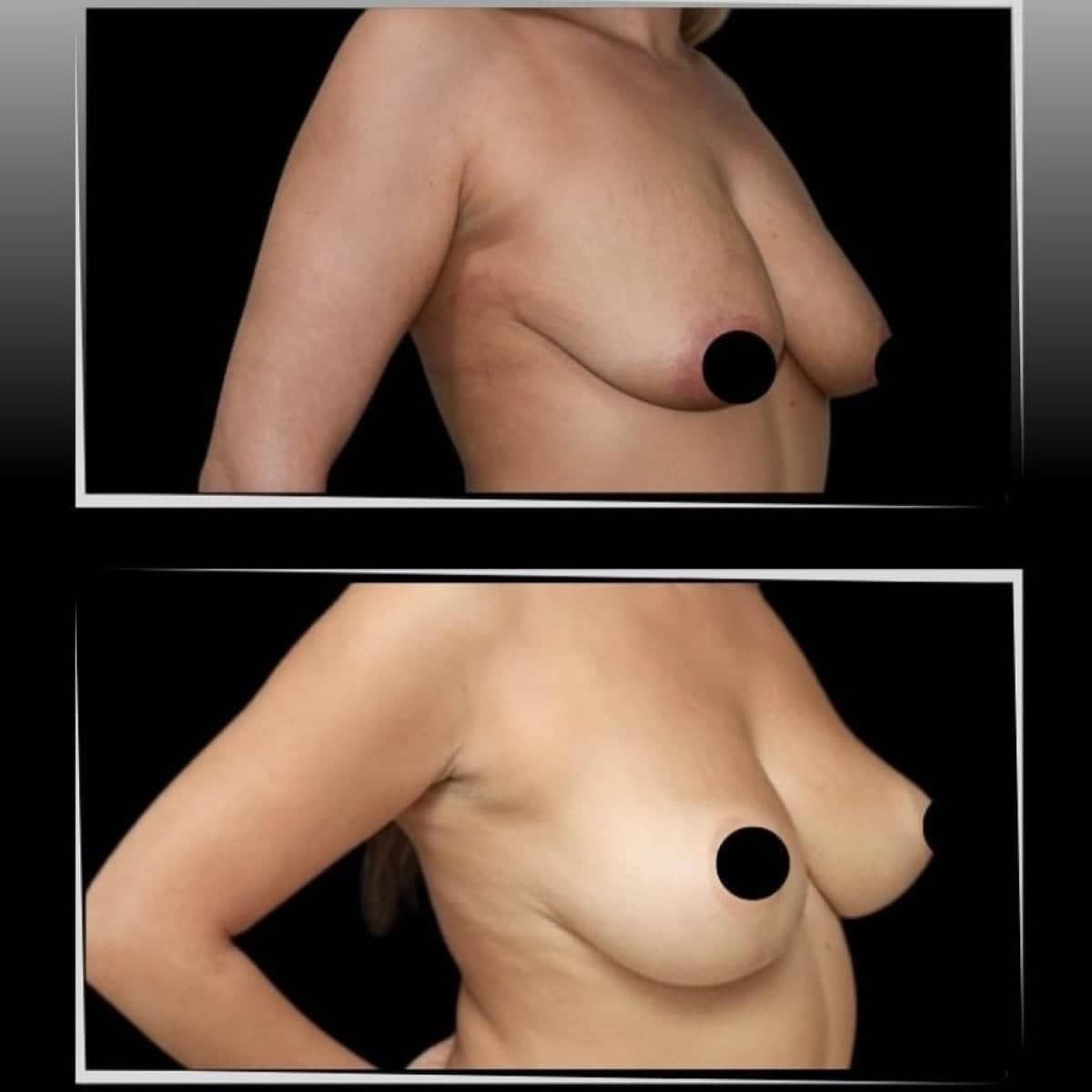 Case 21338 - breast lift