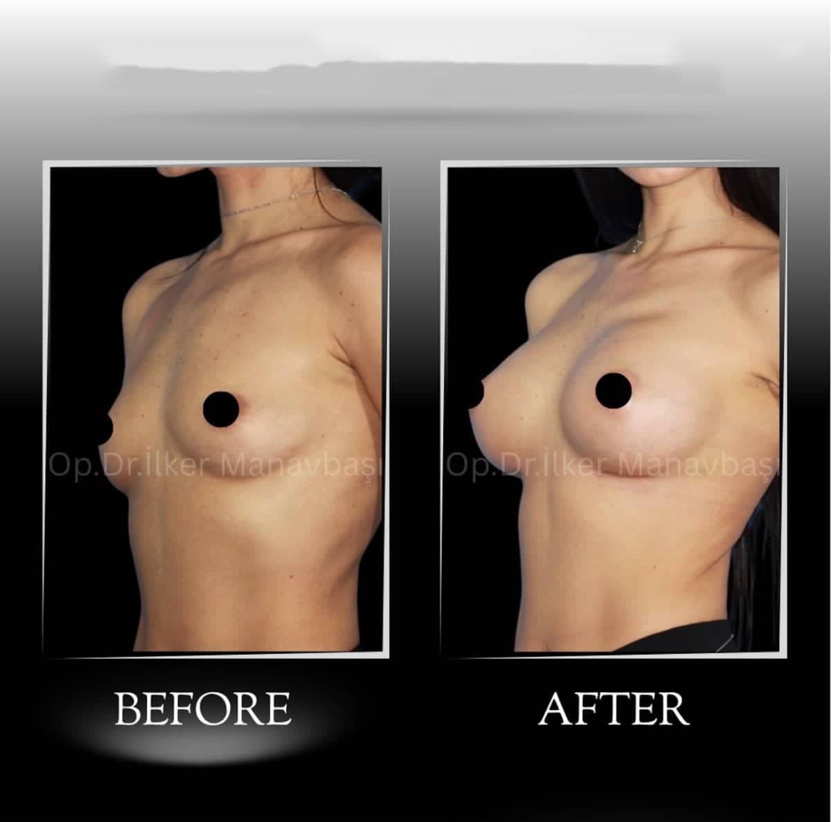 Case 21339 - breast augmentation