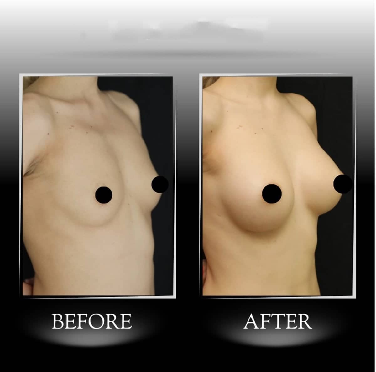 Case 21341 - breast augmentation