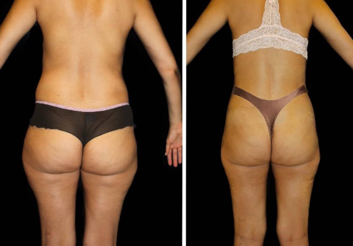 Case 21343 - liposuction 3 body areas