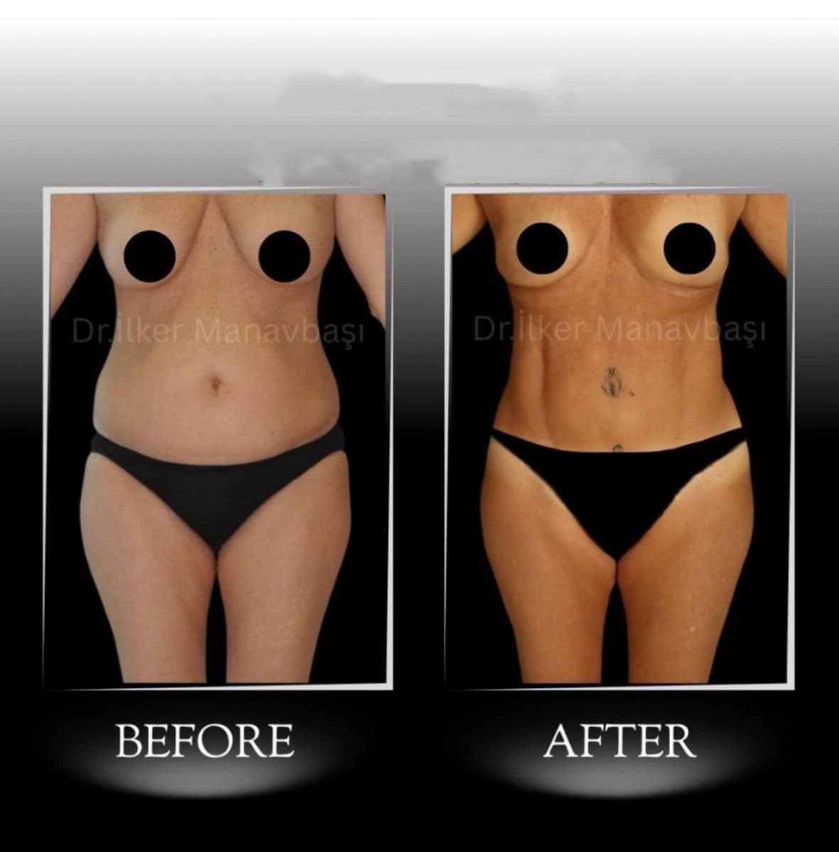 Case 21344 - Vaser 3 areas plus tummy tuck