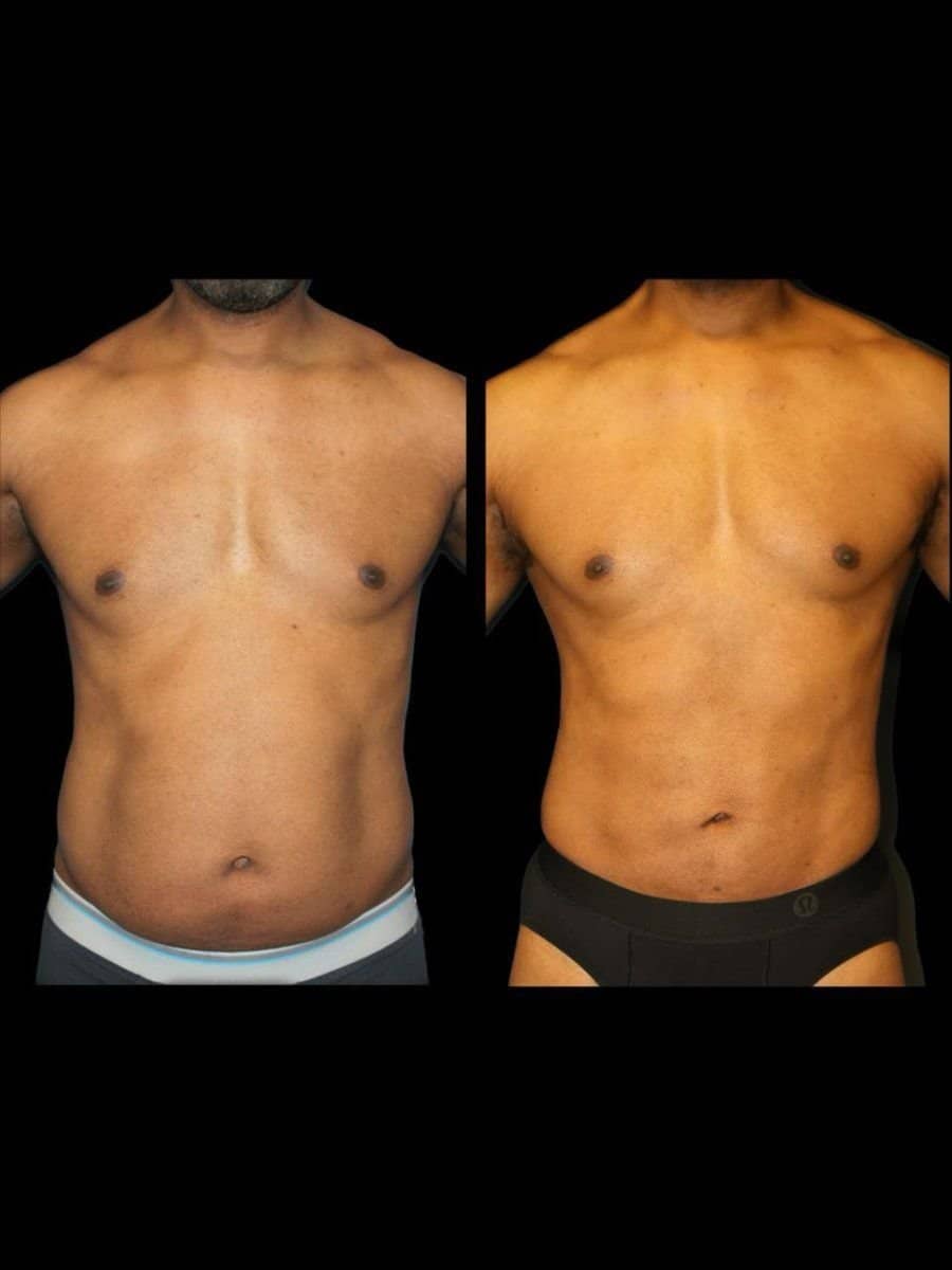 Case 21347 - Vaser liposuction