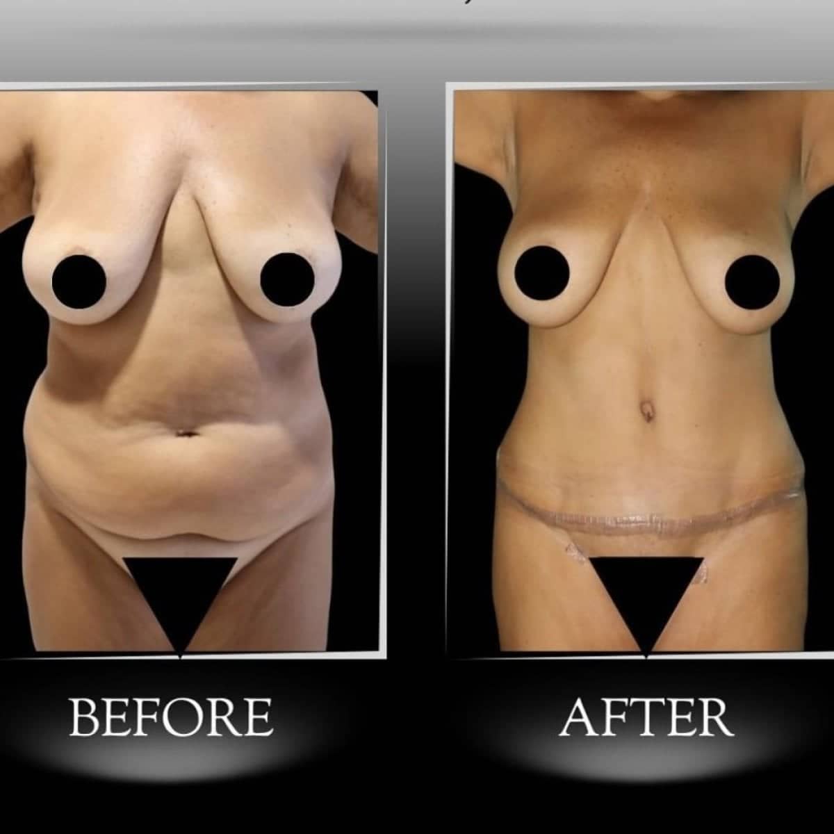 Case 21348 - tummy tuck