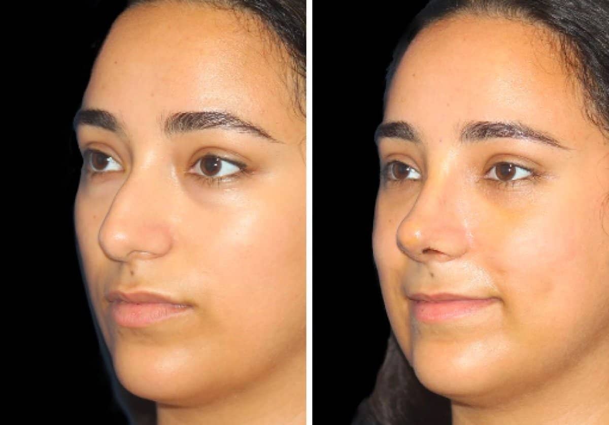 Case 21349 - closed rhinoplasty